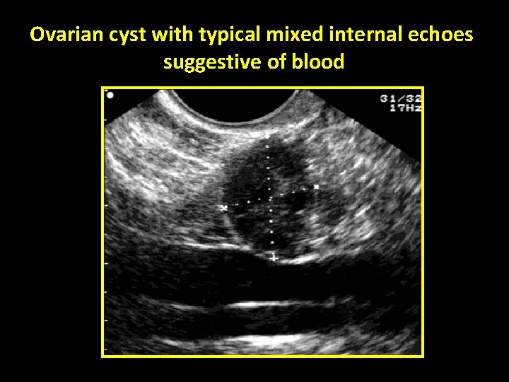 Ovarian cyst with typical mixed internal echoes suggestive of blood 