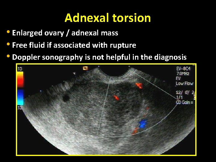 Adnexal torsion • Enlarged ovary / adnexal mass • Free fluid if associated with