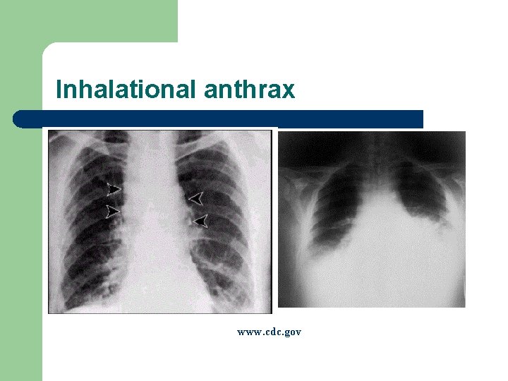 Inhalational anthrax www. cdc. gov 