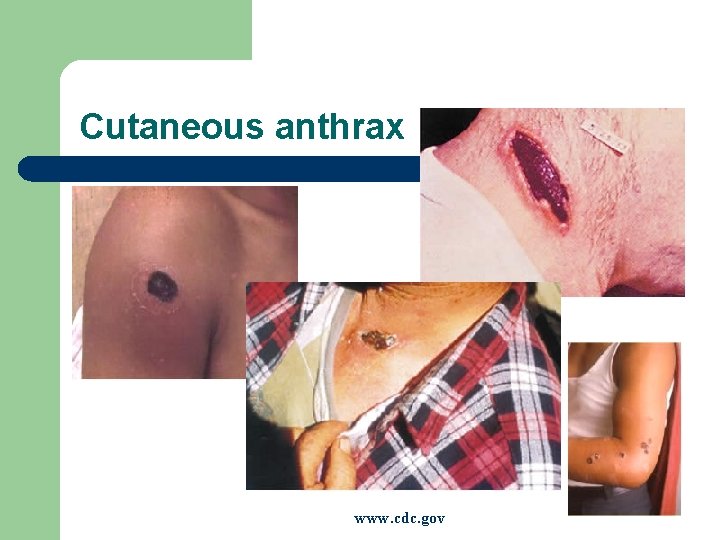Cutaneous anthrax www. cdc. gov 