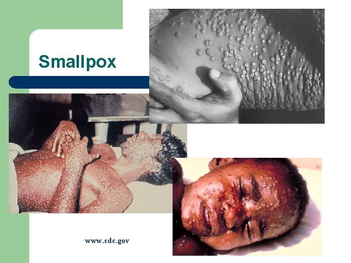 Smallpox www. cdc. gov 