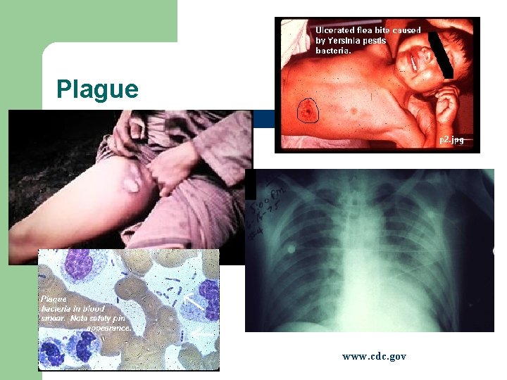 Plague www. cdc. gov 