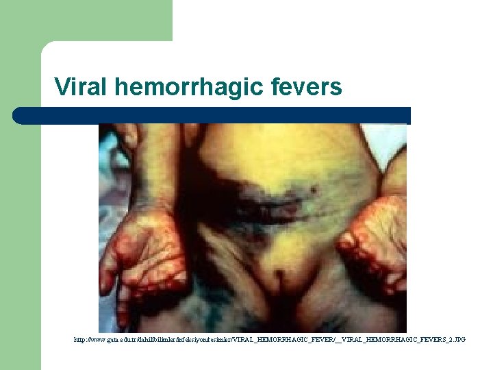 Viral hemorrhagic fevers http: //www. gata. edu. tr/dahilibilimler/infeksiyon/resimler/VIRAL_HEMORRHAGIC_FEVER/__VIRAL_HEMORRHAGIC_FEVERS_2. JPG 