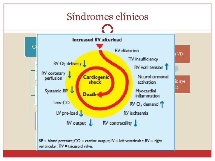 Síndromes clínicos Cor Pulmonar agudo TEP masivo Falla VD Shock y colapso circulatorio, con