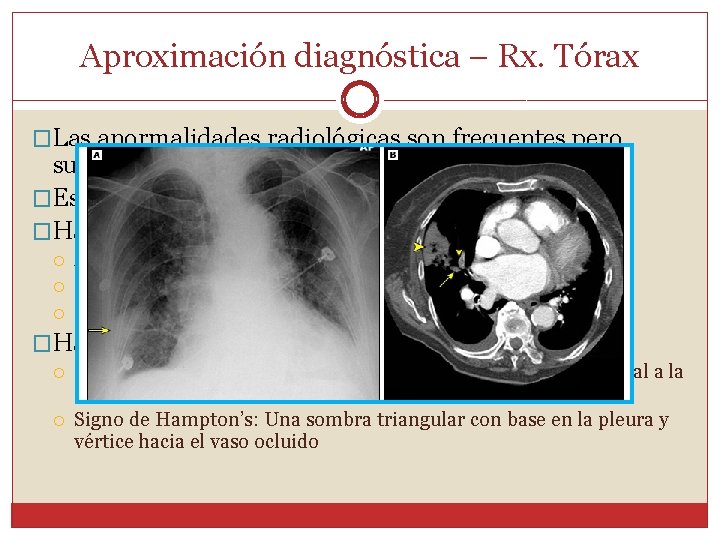 Aproximación diagnóstica – Rx. Tórax �Las anormalidades radiológicas son frecuentes pero suelen ser inespecíficas