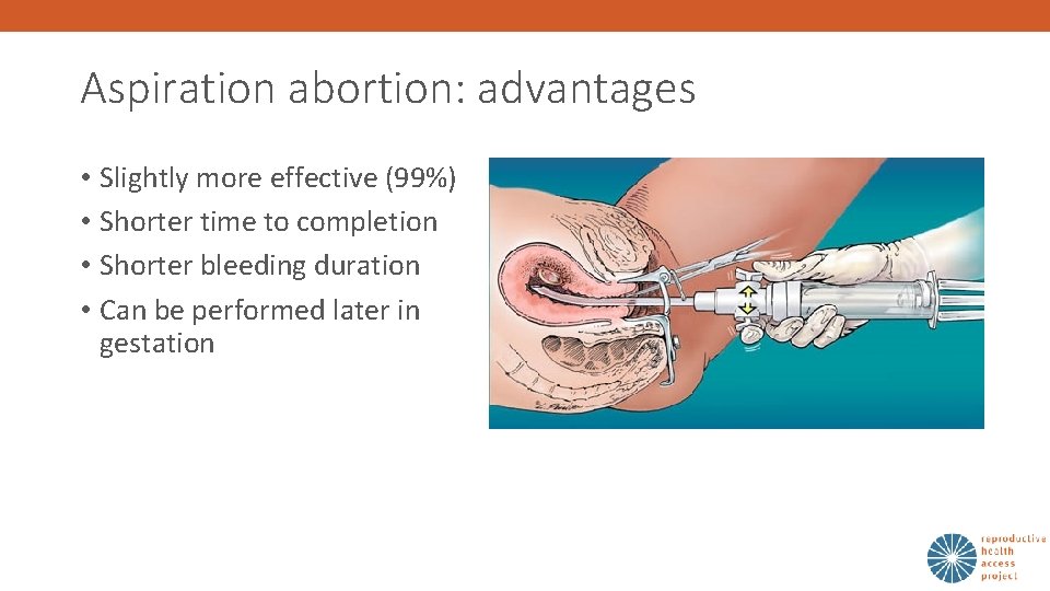 Aspiration abortion: advantages • Slightly more effective (99%) • Shorter time to completion •