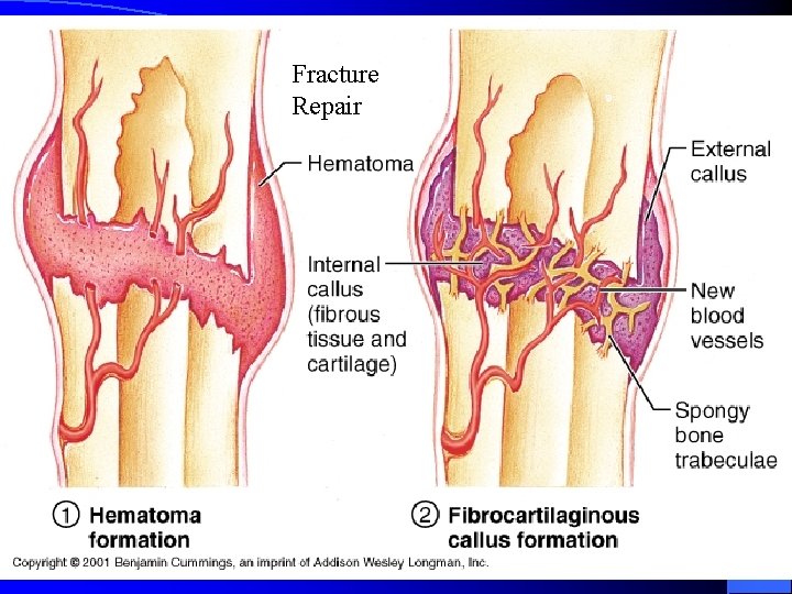 Fracture Repair 