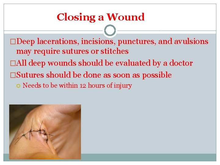 Closing a Wound �Deep lacerations, incisions, punctures, and avulsions may require sutures or stitches Closing a Wound �Deep lacerations, incisions, punctures, and avulsions may require sutures or stitches