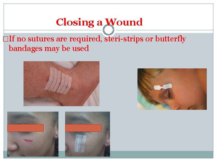 Closing a Wound �If no sutures are required, steri-strips or butterfly bandages may be Closing a Wound �If no sutures are required, steri-strips or butterfly bandages may be