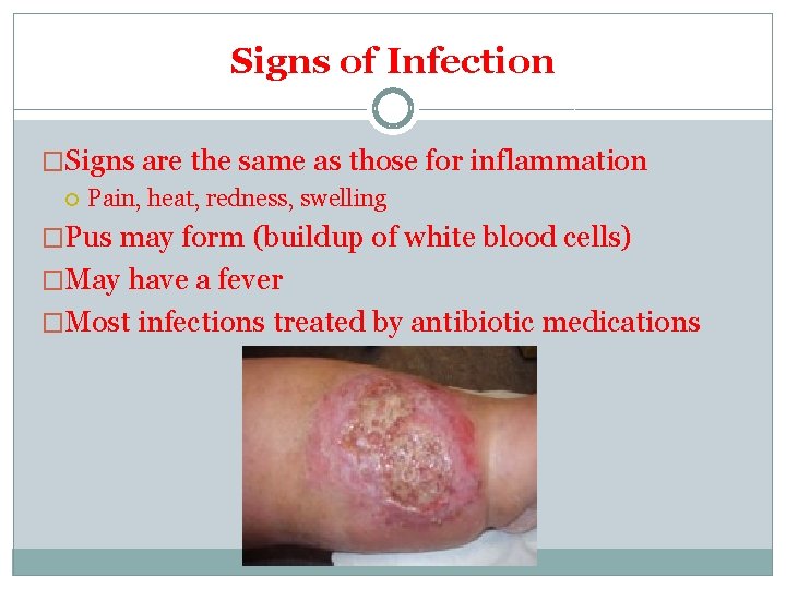 Signs of Infection �Signs are the same as those for inflammation Pain, heat, redness, Signs of Infection �Signs are the same as those for inflammation Pain, heat, redness,