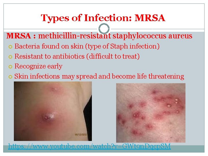 Types of Infection: MRSA : methicillin-resistant staphylococcus aureus Bacteria found on skin (type of Types of Infection: MRSA : methicillin-resistant staphylococcus aureus Bacteria found on skin (type of