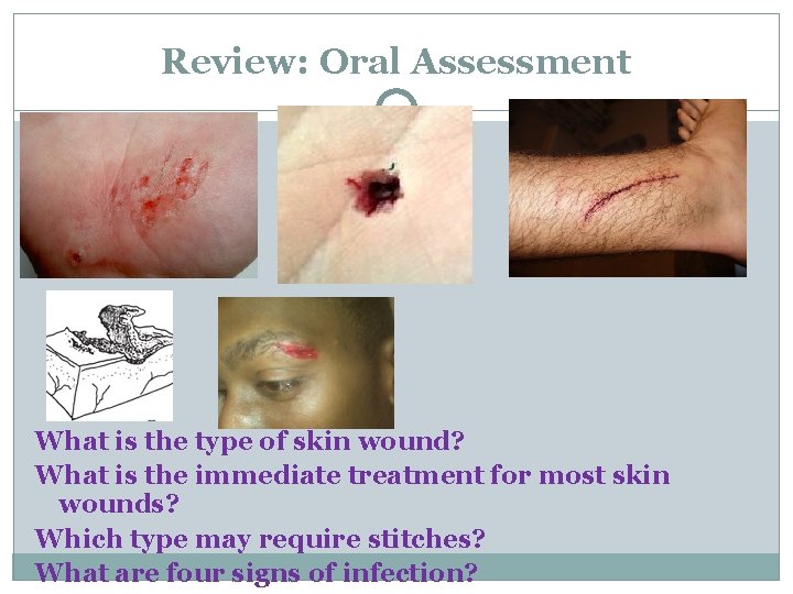 Review: Oral Assessment What is the type of skin wound? What is the immediate Review: Oral Assessment What is the type of skin wound? What is the immediate