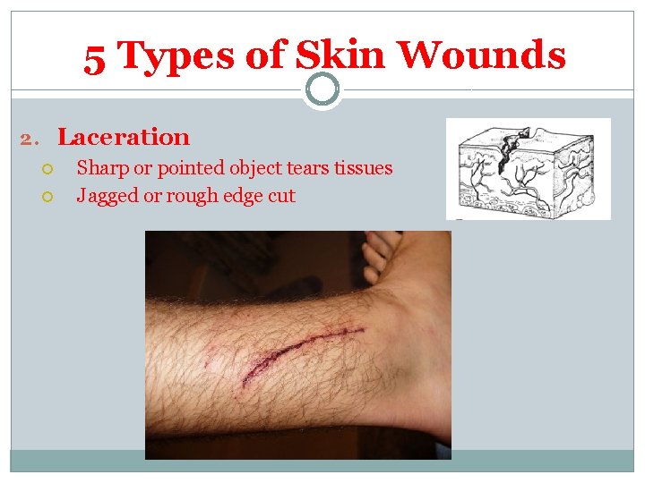 5 Types of Skin Wounds 2. Laceration Sharp or pointed object tears tissues Jagged 5 Types of Skin Wounds 2. Laceration Sharp or pointed object tears tissues Jagged