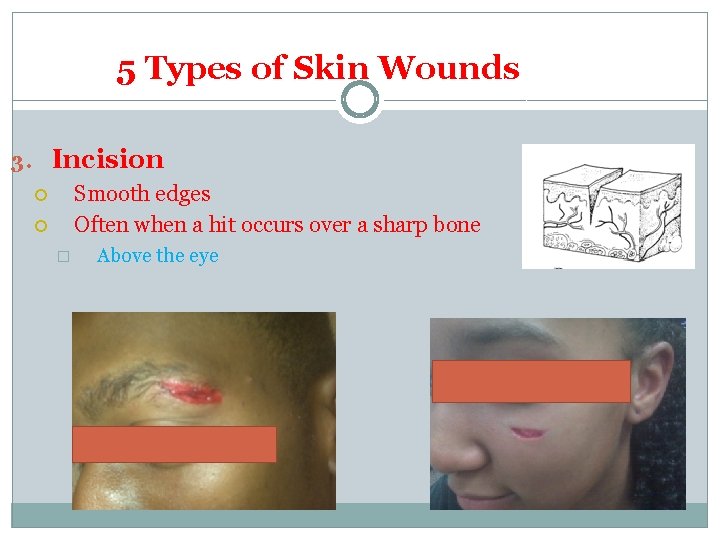 5 Types of Skin Wounds 3. Incision Smooth edges Often when a hit occurs 5 Types of Skin Wounds 3. Incision Smooth edges Often when a hit occurs