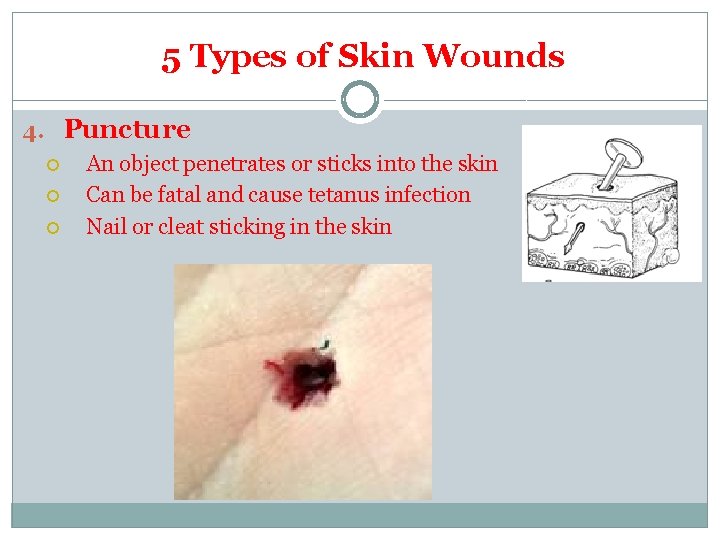 5 Types of Skin Wounds 4. Puncture An object penetrates or sticks into the 5 Types of Skin Wounds 4. Puncture An object penetrates or sticks into the
