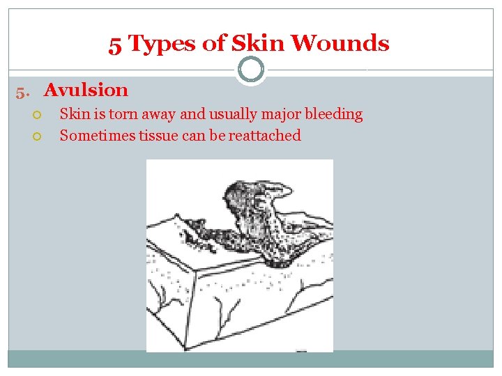 5 Types of Skin Wounds 5. Avulsion Skin is torn away and usually major 5 Types of Skin Wounds 5. Avulsion Skin is torn away and usually major