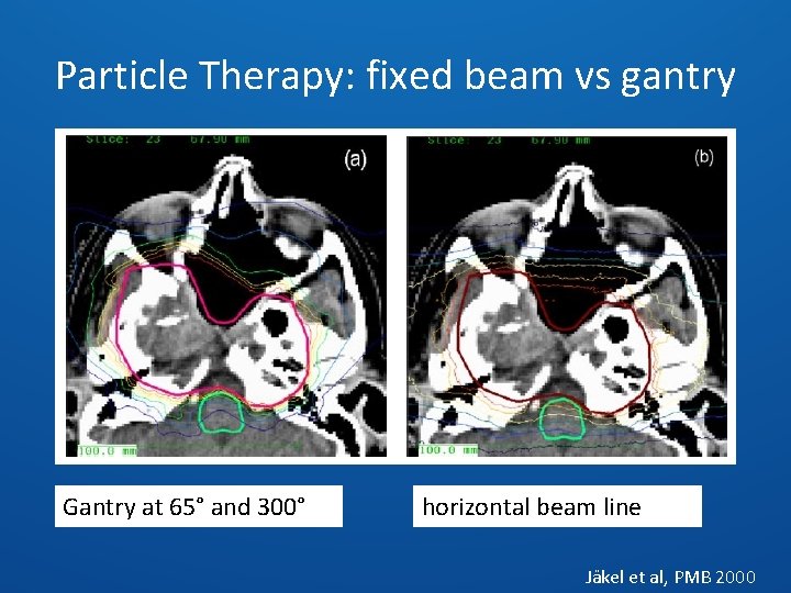 Particle Therapy: fixed beam vs gantry Gantry at 65° and 300° horizontal beam line