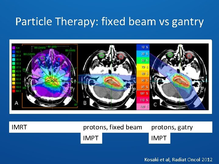 Particle Therapy: fixed beam vs gantry IMRT protons, fixed beam protons, gatry IMPT Kosaki