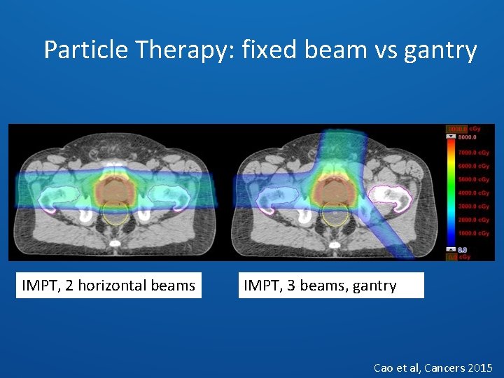 Particle Therapy: fixed beam vs gantry IMPT, 2 horizontal beams IMPT, 3 beams, gantry