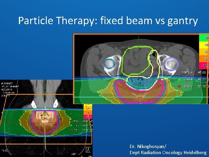 Particle Therapy: fixed beam vs gantry Dr. Nikoghosyan/ Dept Radiation Oncology Heidelberg 