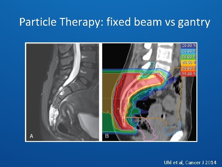 Particle Therapy: fixed beam vs gantry Uhl et al, Cancer J 2014 