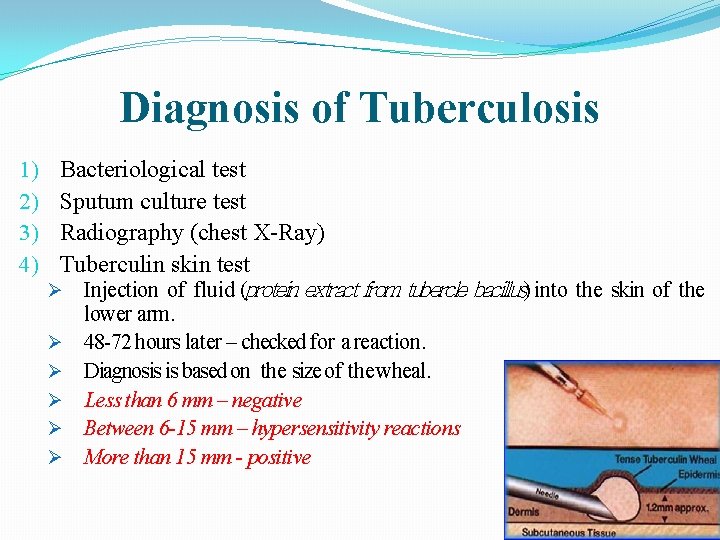 Diagnosis of Tuberculosis 1) 2) 3) 4) Bacteriological test Sputum culture test Radiography (chest