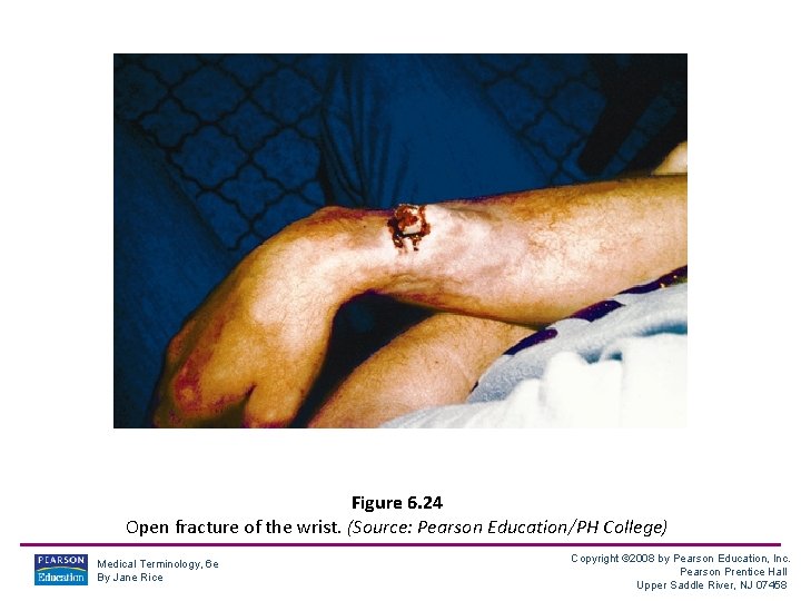 Figure 6. 24 Open fracture of the wrist. (Source: Pearson Education/PH College) Medical Terminology,