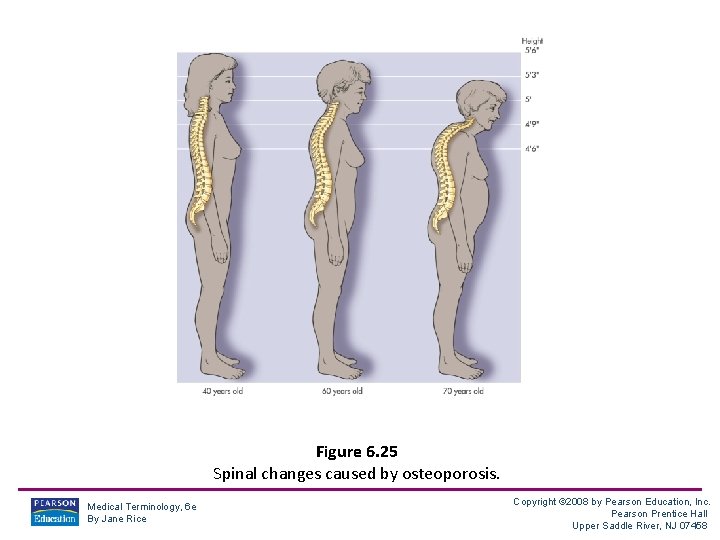 Figure 6. 25 Spinal changes caused by osteoporosis. Medical Terminology, 6 e By Jane