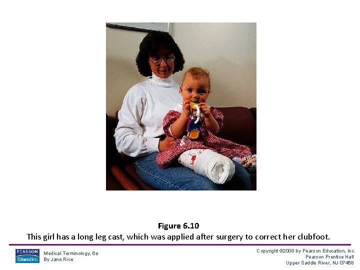 Figure 6. 10 This girl has a long leg cast, which was applied after