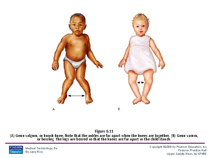 Figure 6. 11 (A) Genu valgum, or knock-knee. Note that the ankles are far