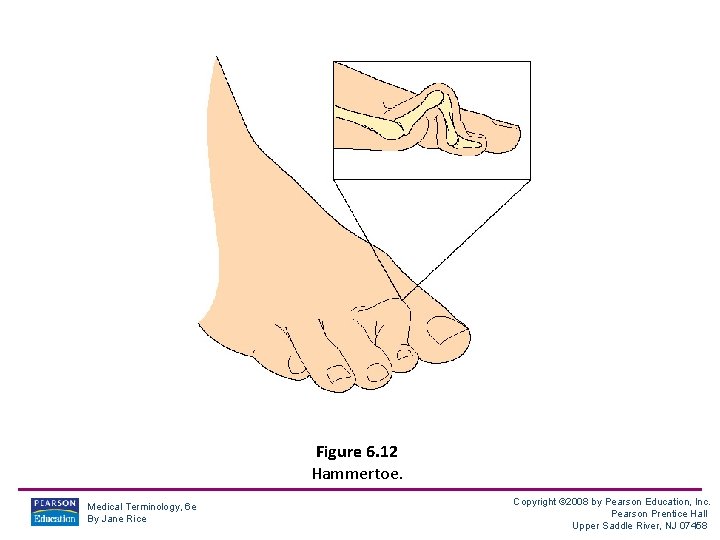 Figure 6. 12 Hammertoe. Medical Terminology, 6 e By Jane Rice Copyright © 2008