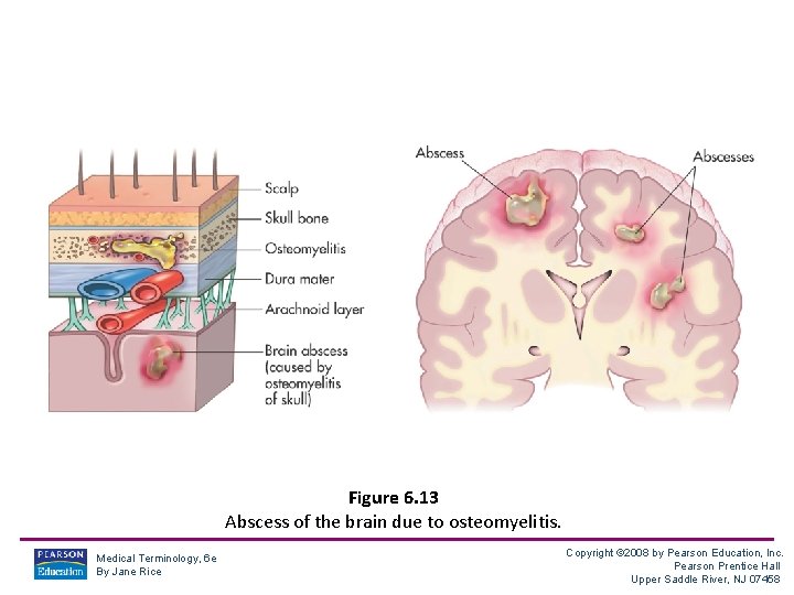 Figure 6. 13 Abscess of the brain due to osteomyelitis. Medical Terminology, 6 e