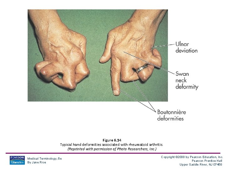 Figure 6. 14 Typical hand deformities associated with rheumatoid arthritis. (Reprinted with permission of