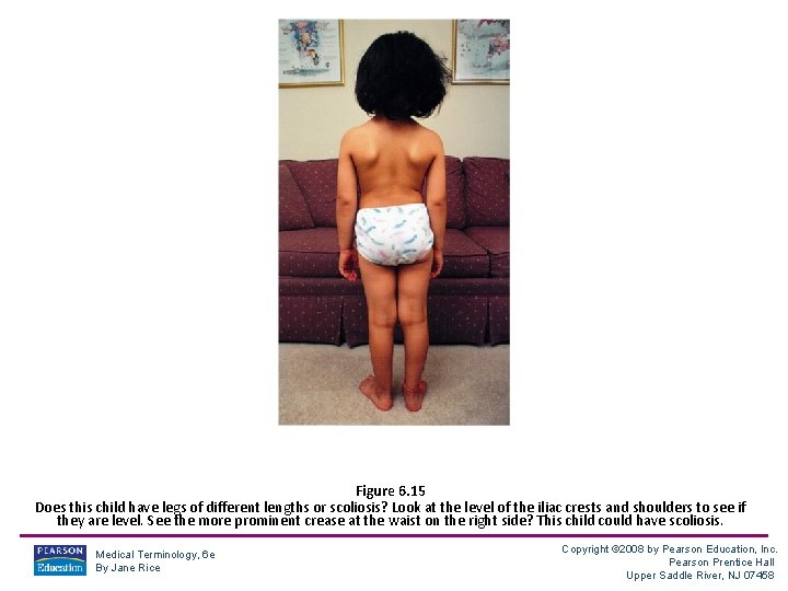 Figure 6. 15 Does this child have legs of different lengths or scoliosis? Look