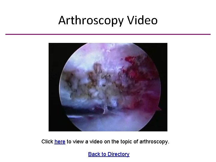 Arthroscopy Video Click here to view a video on the topic of arthroscopy. Back