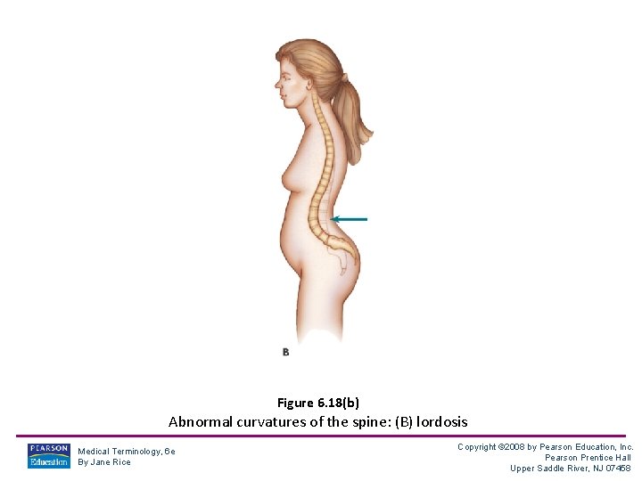 Figure 6. 18(b) Abnormal curvatures of the spine: (B) lordosis Medical Terminology, 6 e