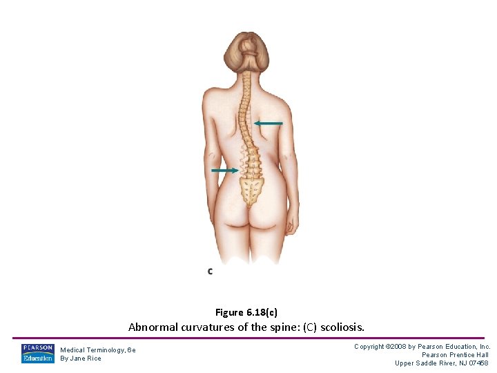 Figure 6. 18(c) Abnormal curvatures of the spine: (C) scoliosis. Medical Terminology, 6 e
