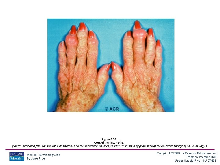 Figure 6. 20 Gout of the finger joint. (Source: Reprinted from the Clinical Slide