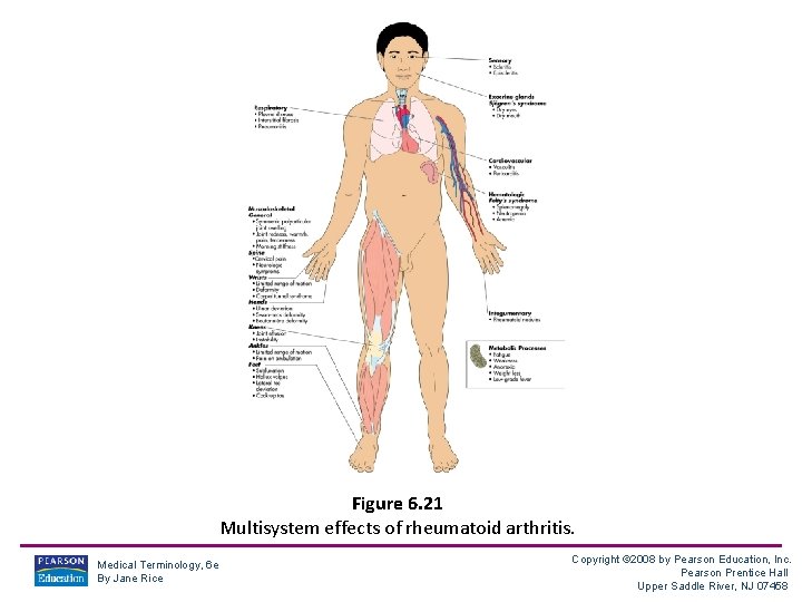 Figure 6. 21 Multisystem effects of rheumatoid arthritis. Medical Terminology, 6 e By Jane