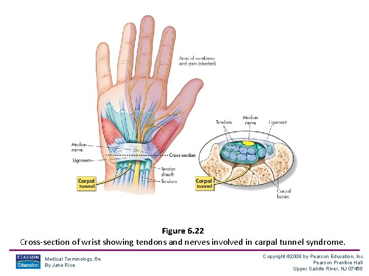 Figure 6. 22 Cross-section of wrist showing tendons and nerves involved in carpal tunnel