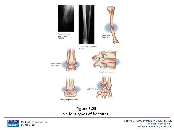 Figure 6. 23 Various types of fractures. Medical Terminology, 6 e By Jane Rice