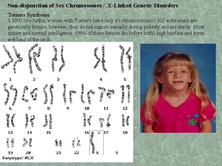 Non-disjunction of Sex Chromosomes / X-Linked Genetic Disorders Turners Syndrome 1: 5000 live births;