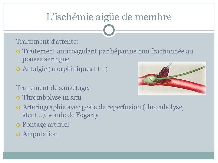 L’ischémie aigüe de membre Traitement d’attente: Traitement anticoagulant par héparine non fractionnée au pousse