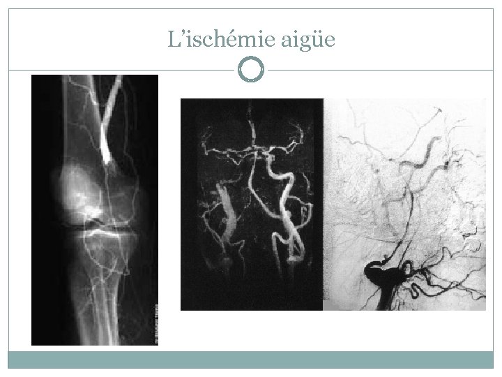 L’ischémie aigüe 