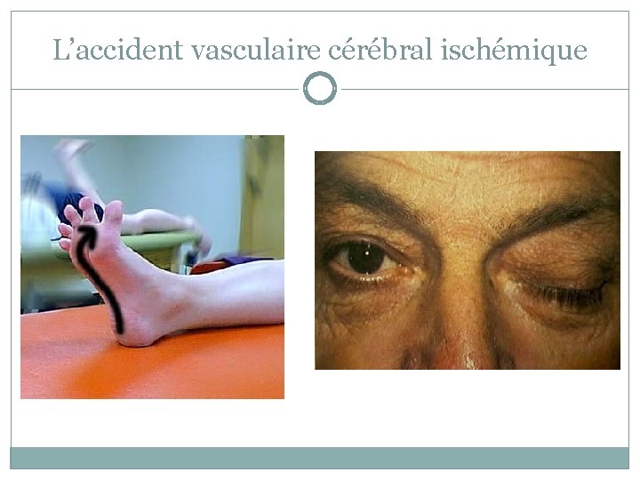 L’accident vasculaire cérébral ischémique 