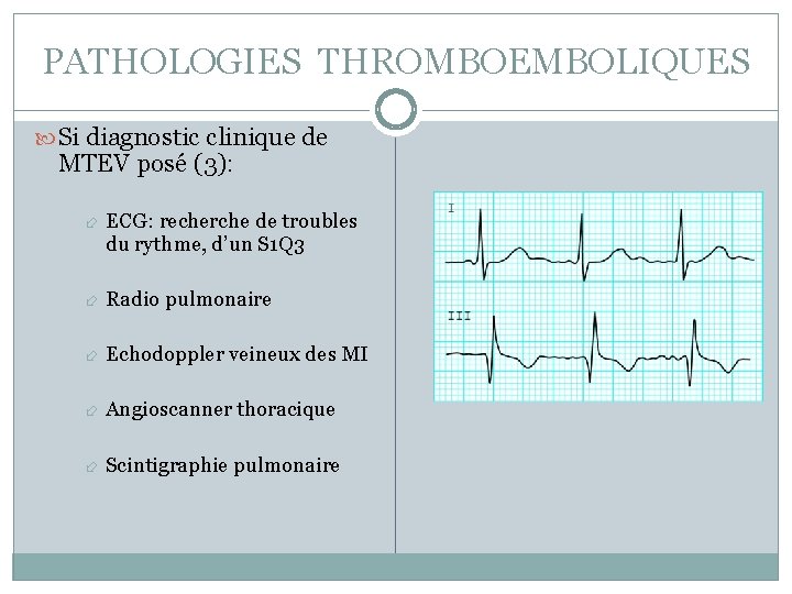 PATHOLOGIES THROMBOEMBOLIQUES Si diagnostic clinique de MTEV posé (3): ECG: recherche de troubles du