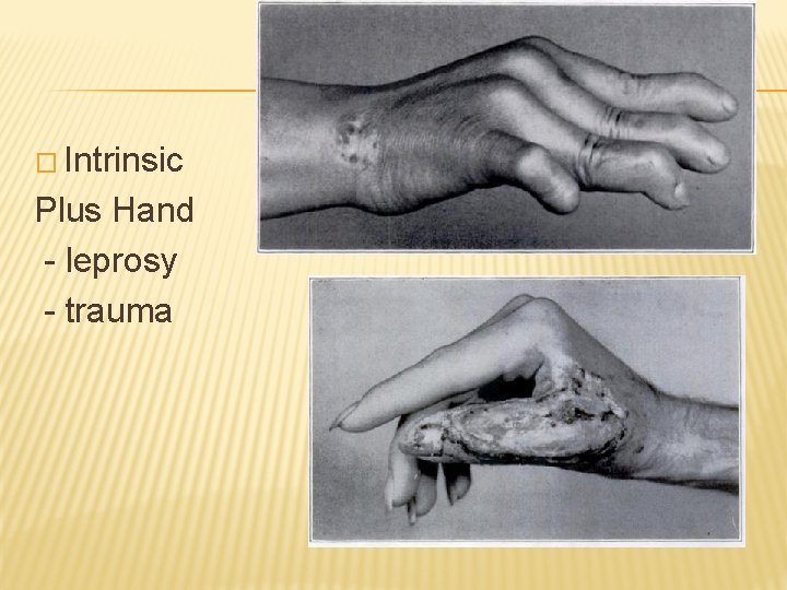 � Intrinsic Plus Hand - leprosy - trauma 