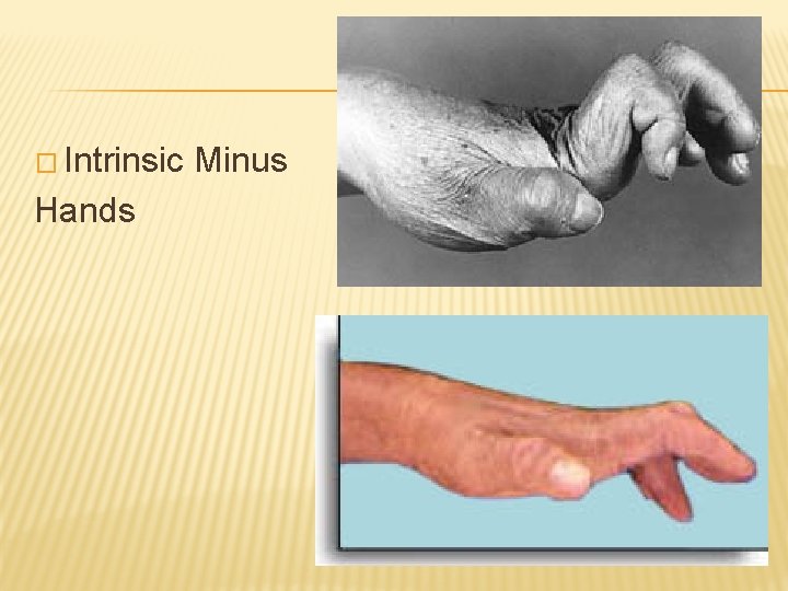 � Intrinsic Hands Minus 