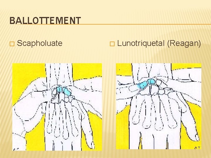 BALLOTTEMENT � Scapholuate � Lunotriquetal (Reagan) 