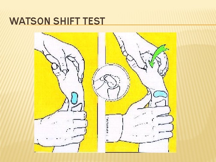 WATSON SHIFT TEST 